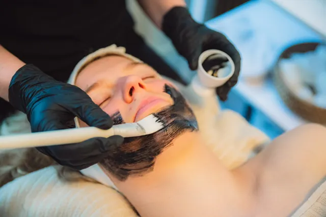 Foto fra VIDA Skønhedsklinik af en Carbon Peeling-behandling af ansigtet