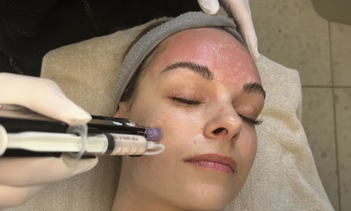 Microneedling-behandling i gang hos VIDA Skønhedsklinik