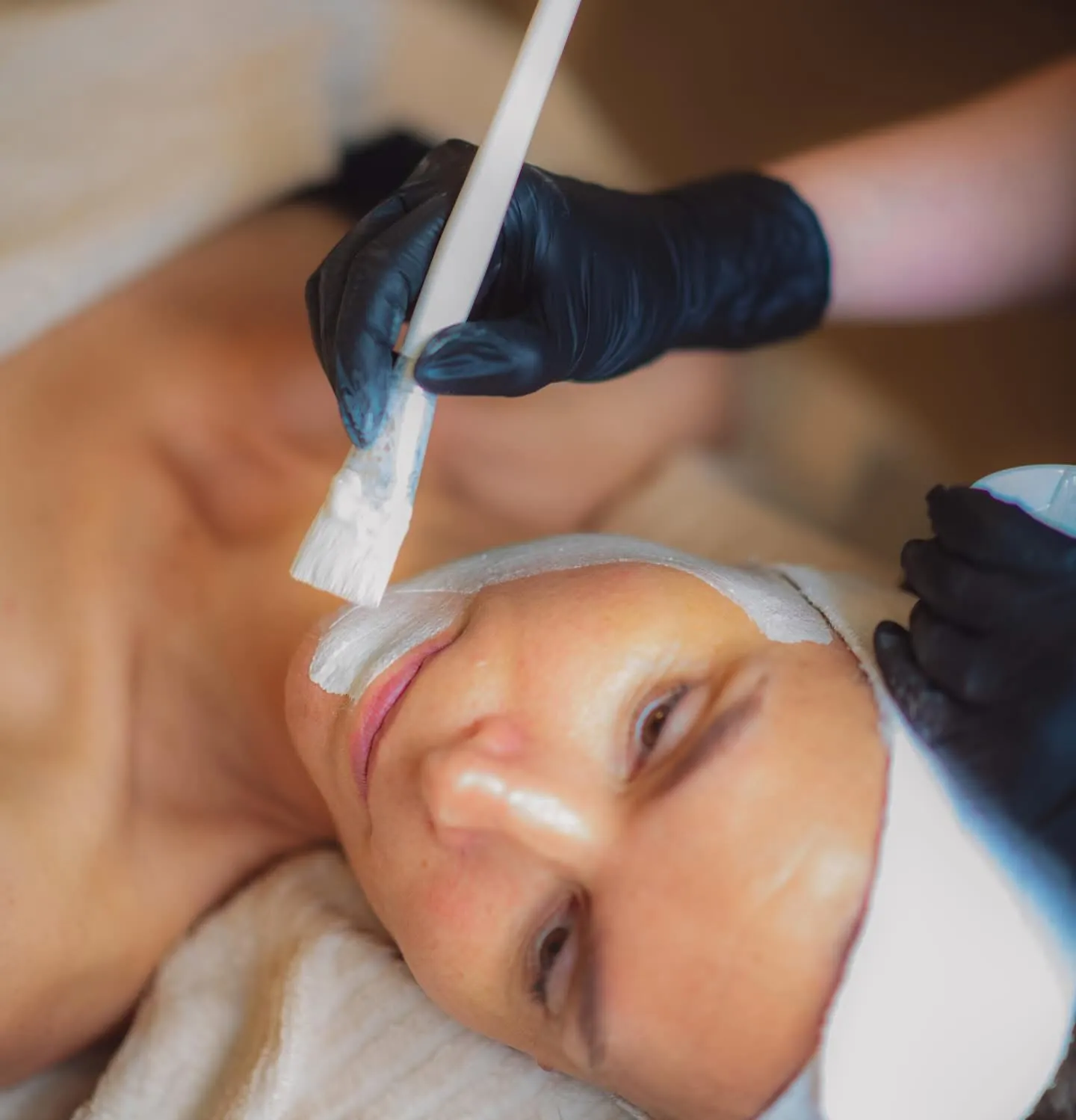 Foto fra VIDA Skønhedsklinik af en Release Peeling-behandling af ansigtet